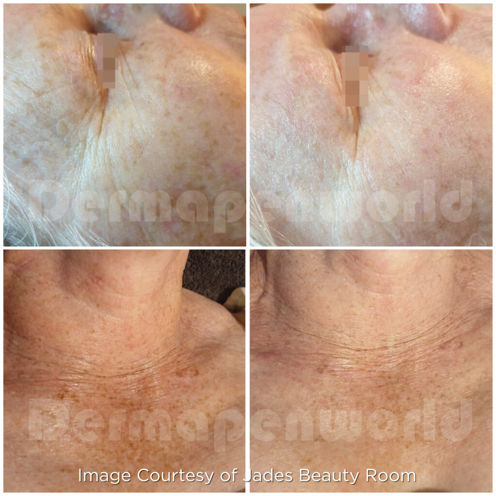 Dermapen Microneedling Results